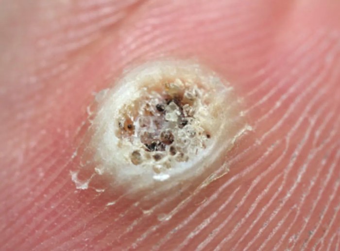 Verruca wart warts